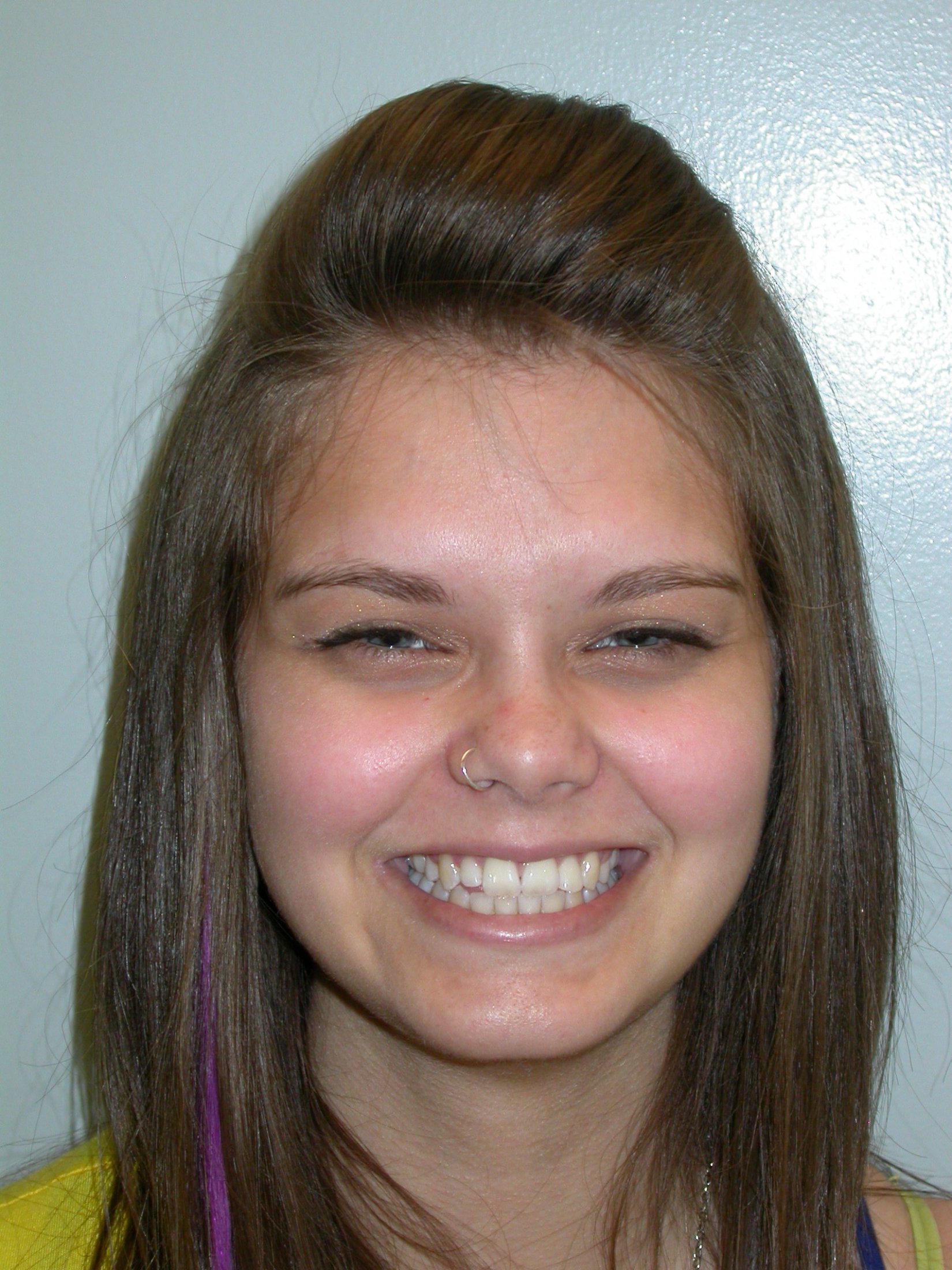 Before & After Jaw Surgery Kingston and Belleville ON,