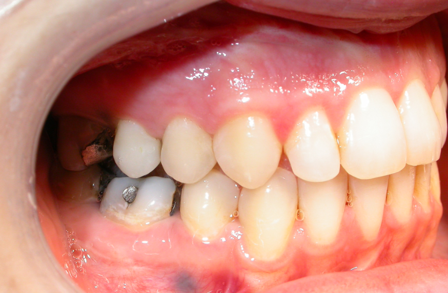 Before & After Jaw Surgery Kingston and Belleville ON,